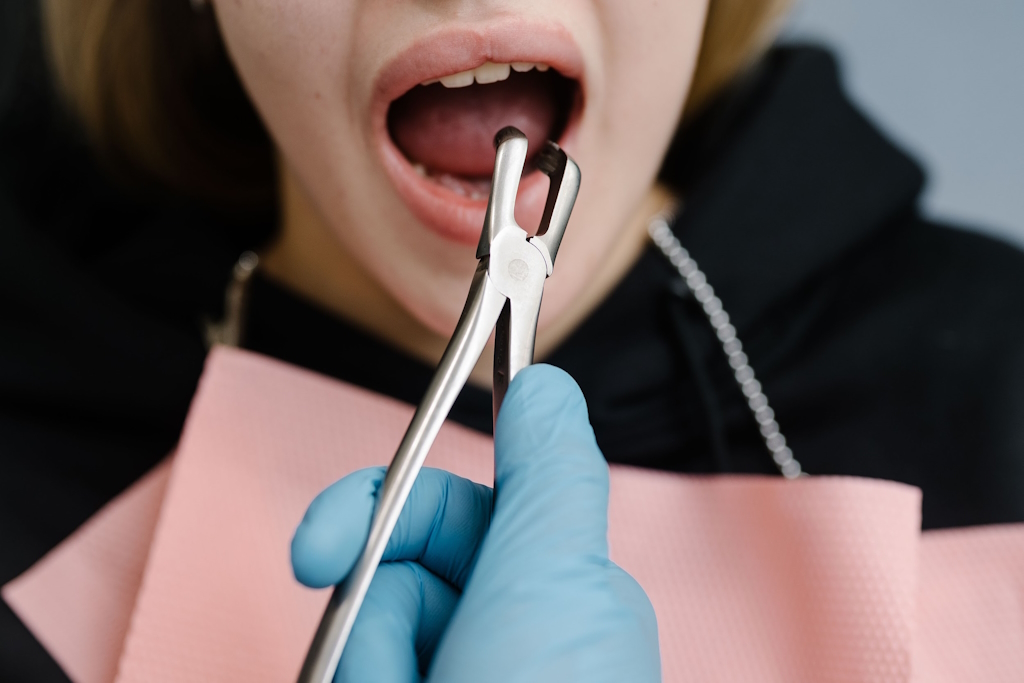 Що нам відомо про видалення зубів?